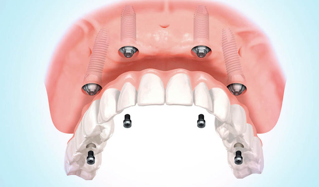 implantes dentales en Zaidía - Valencia