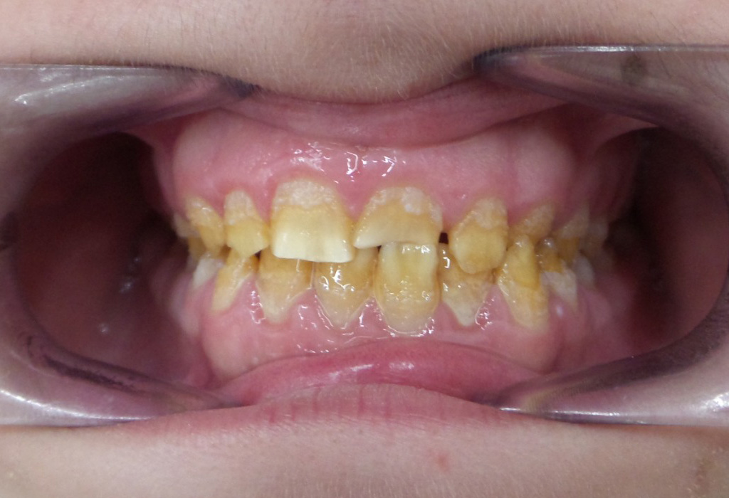 cas real d'estètica dental