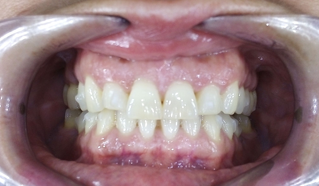 caso real de ortodoncia