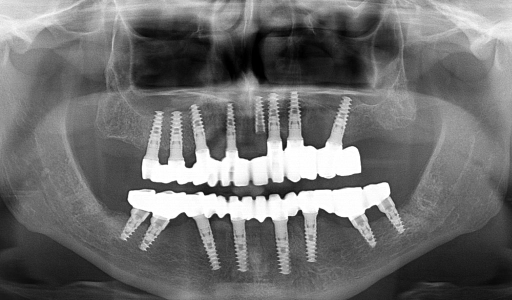 caso real de implantes dentales