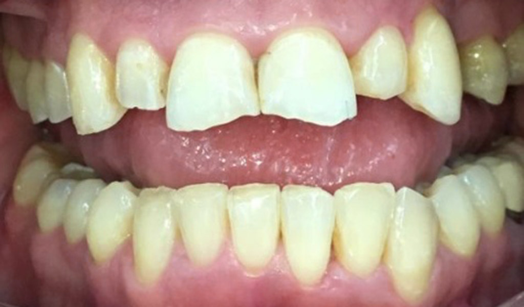 caso real de ortodoncia, carillas e implante