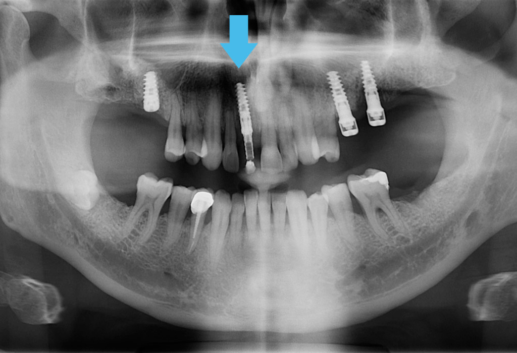 caso real implantes dentales