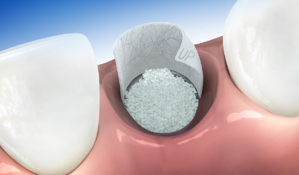 implantes dentales en Terrassa